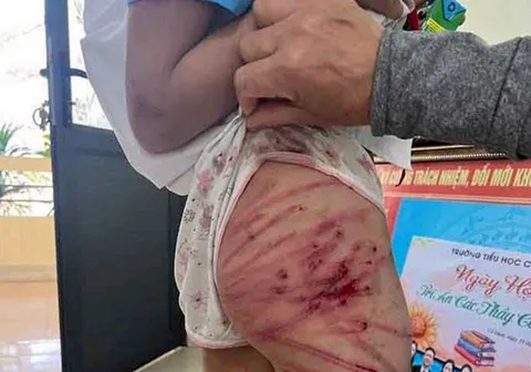 Bé gái bị thương nặng, phải nhập viện cấp cứu